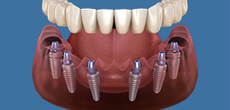 Studio dentistico bulzomi implantologia all on six