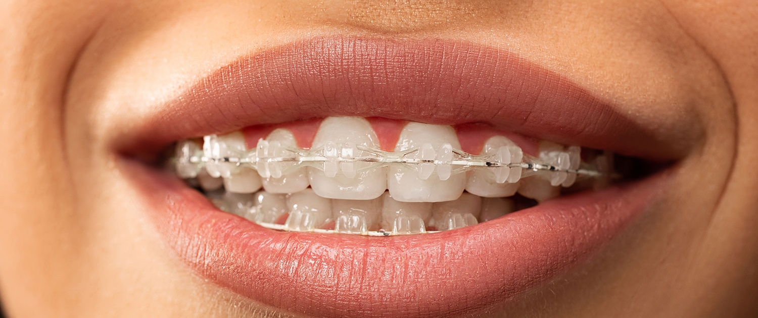 Studio dentistico bulzomi ortodonzia attacchi estetici